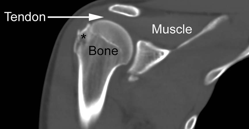 CT SCAN SHOULDER (PLAIN)