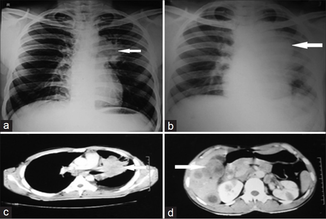 CT SCAN CHEST CONTRAST