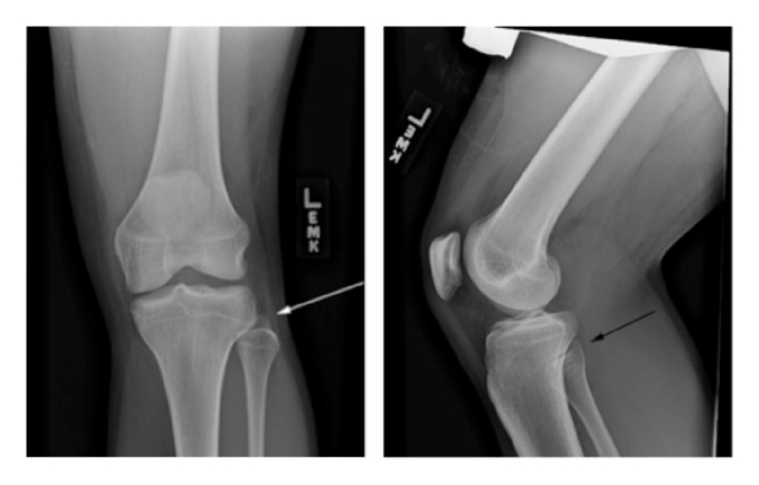 X-RAY AP/LATERAL VIEW BOTH KNEE