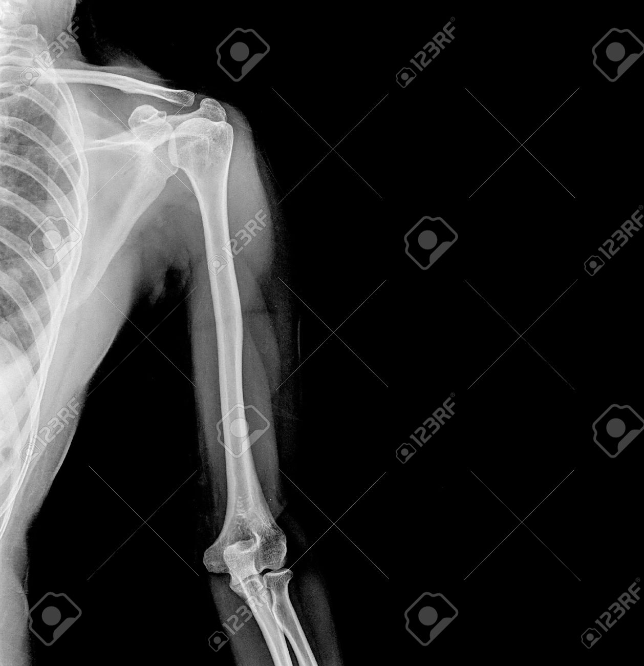 X-RAY LATERAL VIEW ARM