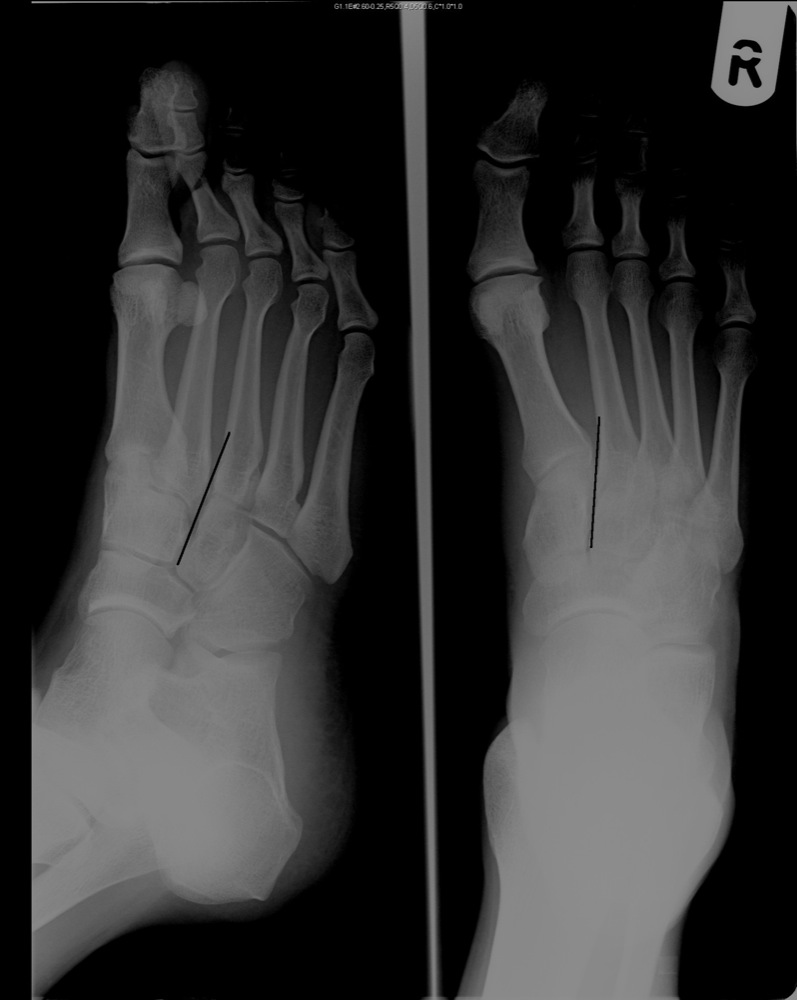 X-RAY AP/LATERAL VIEW BOTH FOOT